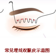 岳陽(yáng)愛思特整形醫(yī)院雙眼皮怎么樣