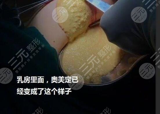 奥美定可以溶解掉吗