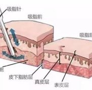 泉州做吸脂好的醫(yī)生有哪些