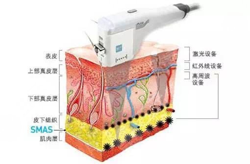 臉上紅血絲如何去除