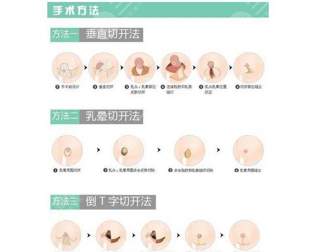 如何让胸变大整形图片