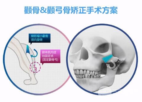 张笑天磨骨价格是多少