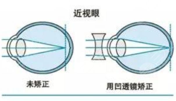 激光近視手術(shù)度數(shù)范圍是多少