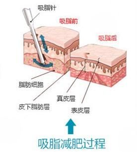 成都李发展抽脂怎么样