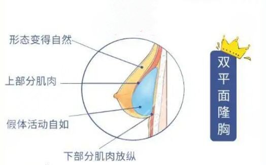 隆胸假体品牌十大排行榜哪个好