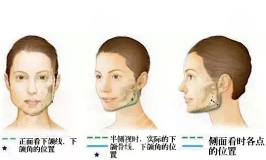 上海九院韦敏下颌角磨骨瘦脸案例价格表大全曝光