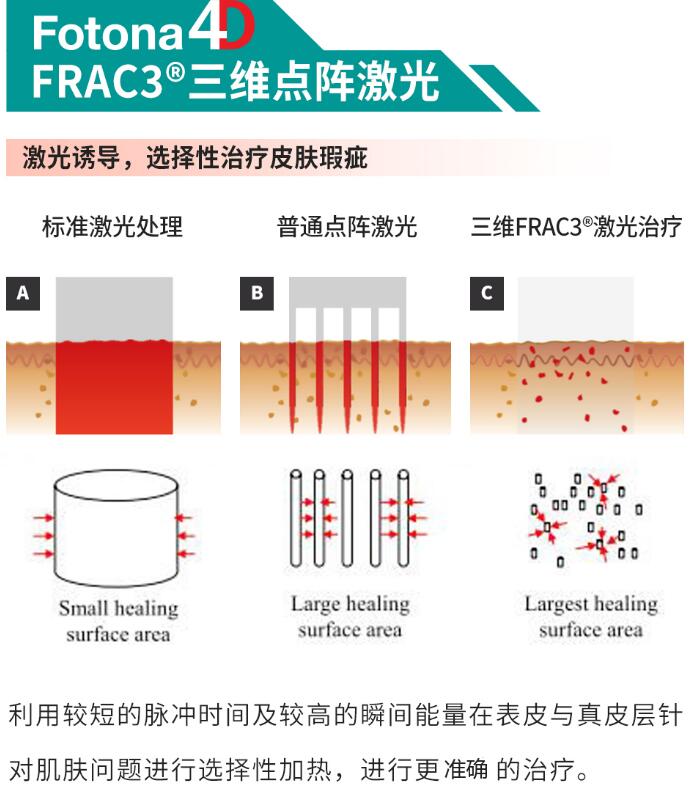 歐洲之星激光祛斑介紹來啦