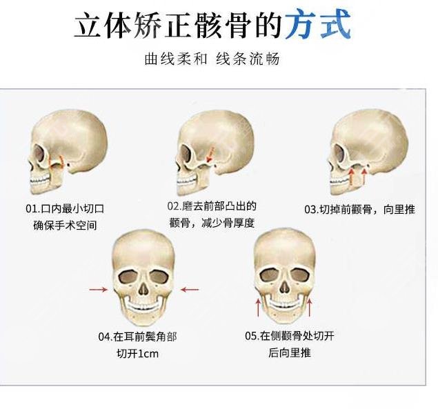北京下颌角手术专家名单