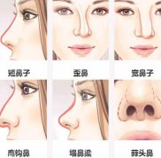 北京八大處王克明隆鼻價格案例肋軟骨隆鼻整形果對比圖分享