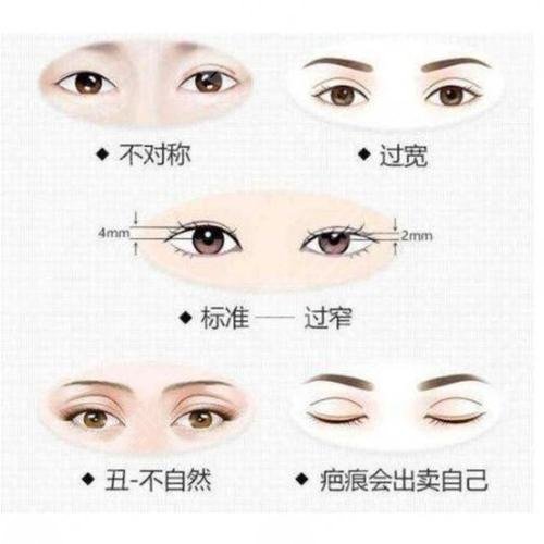 广州修复双眼皮哪个医生比较好