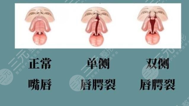 唇腭裂修復(fù)手術(shù)大概需要多少費(fèi)用