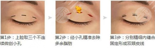 广州南方医院双眼皮手术哪个医生好