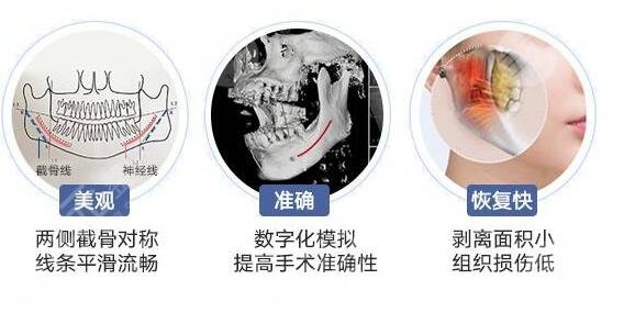 南京颧骨内推和下颌角手术费用及医生名单