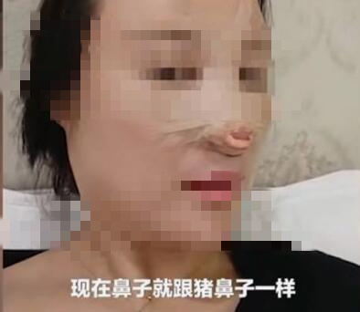 女子隆鼻變豬鼻子驚呆記者