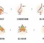 長沙李高峰擅長做鼻子嗎