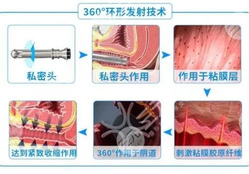 歐洲之星私密點(diǎn)陣激光價(jià)位是多少