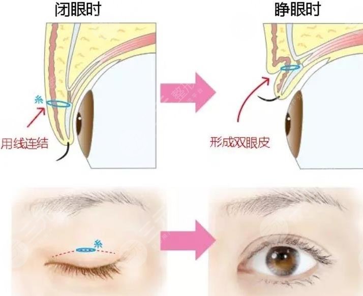 济南割双眼皮比较好的医生名单