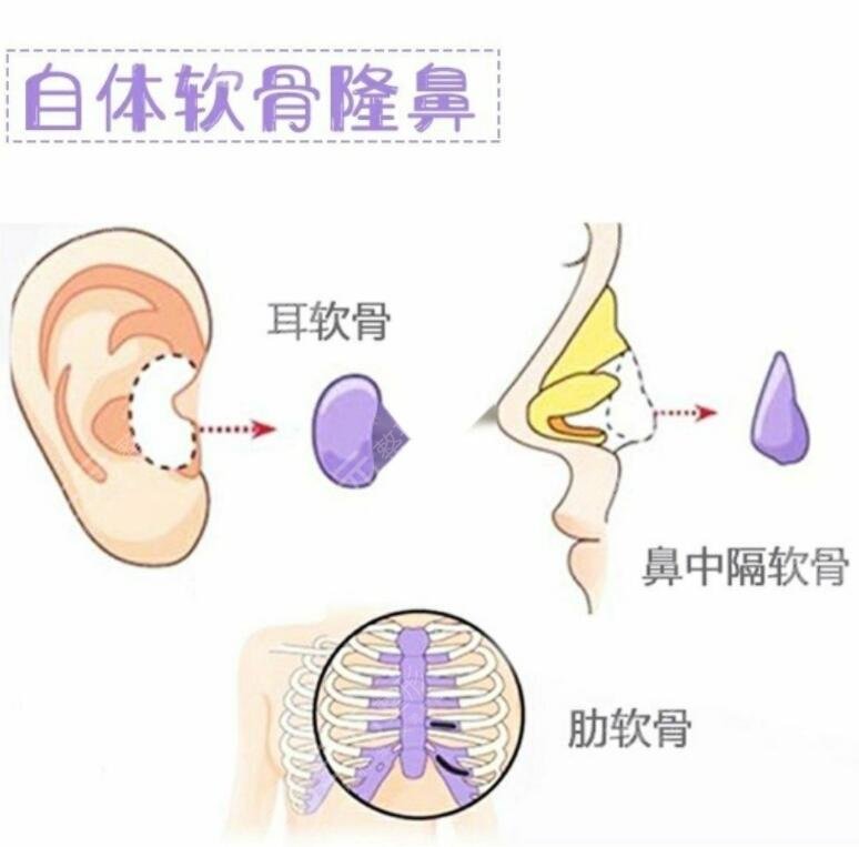 上海李安平肋骨鼻怎么樣