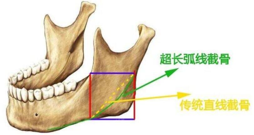 八大处磨骨哪个医生好