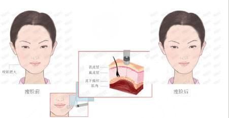 注射瘦脸需要多少钱