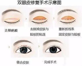 武汉做双眼皮修复前10名的医生排行榜公布