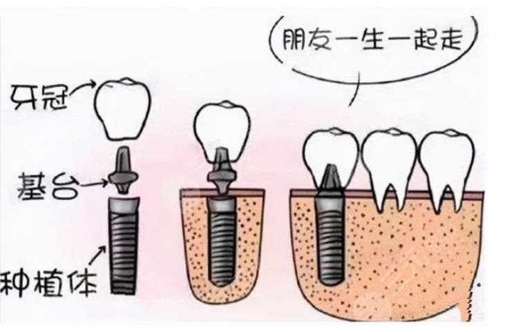 北京种植牙多少钱一颗