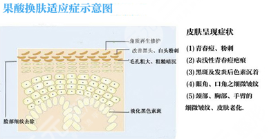 果酸換膚的功效是什么