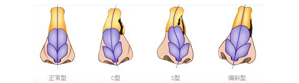 丹東第(一)醫(yī)院歪鼻矯正的手術(shù)費用是多少