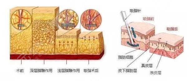 面部吸脂會(huì)不會(huì)導(dǎo)致皮膚松弛