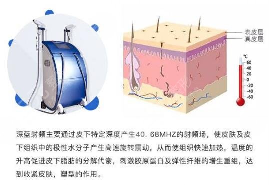 深藍(lán)射頻和光子嫩膚哪個(gè)好