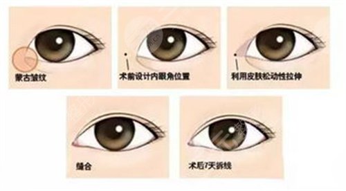 广州军区武汉总院割双眼皮医生邱伟明、案例真人反馈图