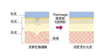 塑美極和熱瑪吉區(qū)別是什么