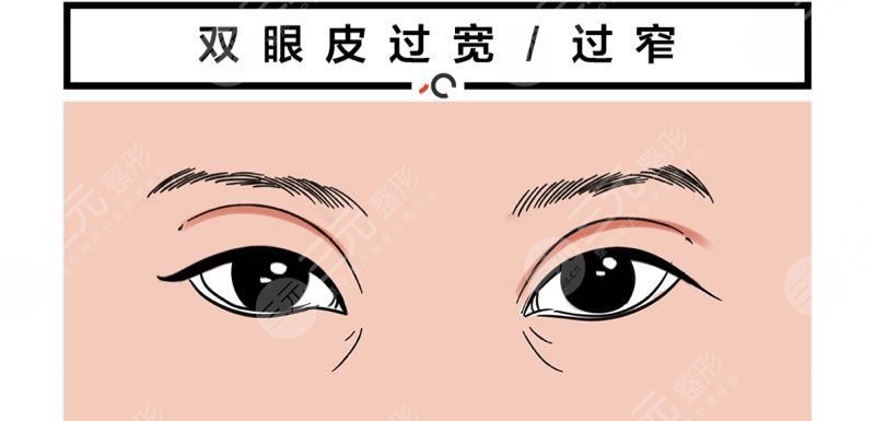 上海美莱杜园园做眼部综合整形怎么样