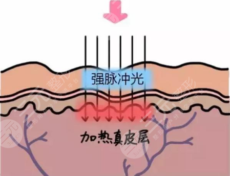 深藍(lán)射頻和光子嫩膚哪個(gè)好