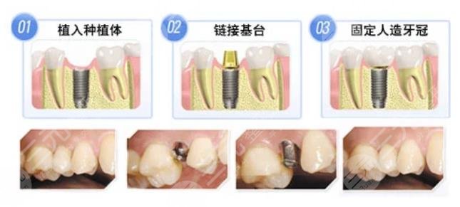 2022北京种植牙口腔医院排名榜出炉