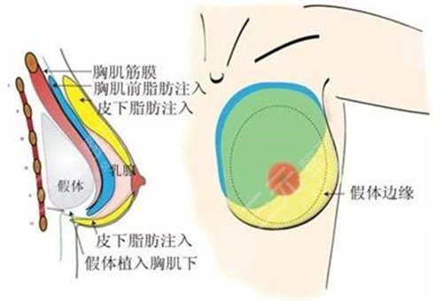 缩胸手术风险大吗