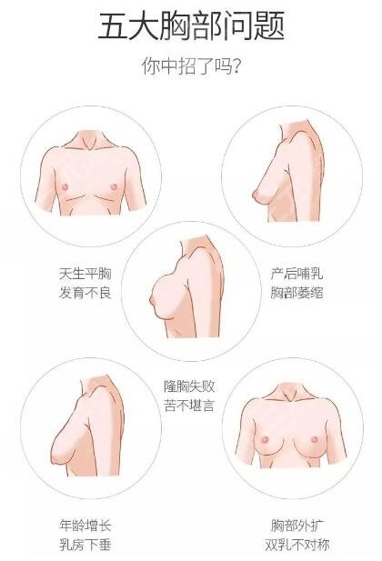 深圳军科整形医院做的复合隆胸真实案例分享