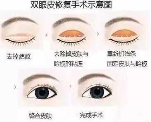 上海谁做双眼皮修复好