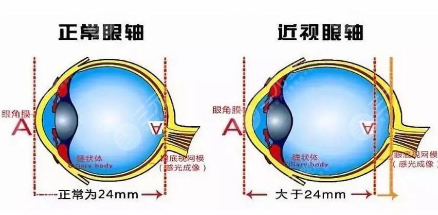 激光近視手術(shù)度數(shù)范圍是多少