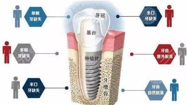 上海种植牙哪家医院比较好性价比又高