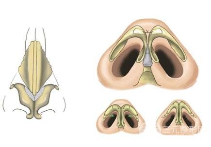 巫文云隆鼻修复手术价格