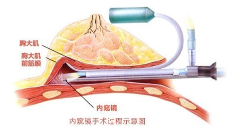 北京自体脂肪丰胸医院哪些好