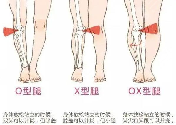 x型腿怎么矯正