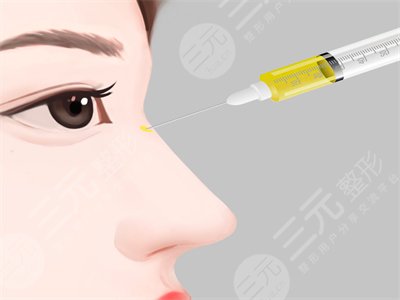 在重庆华美整形做的玻尿酸隆鼻真实案例分享