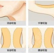 南通吸脂醫(yī)院排名前三、前五、前十大公布