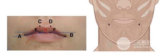 A型注射瘦脸的应用