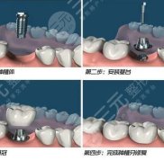 寧波種牙醫(yī)院排名前三、前五、前十來(lái)襲~醫(yī)院口碑測(cè)評(píng)&amp