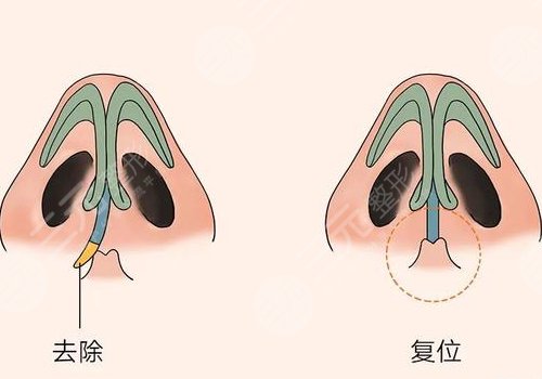 郑永生歪鼻矫正怎么样