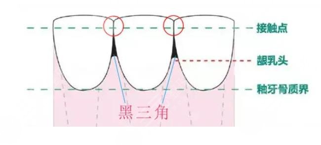 成年以后千萬別整牙是真的嗎