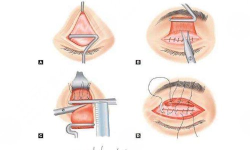 上瞼下垂幾歲做手術(shù)好